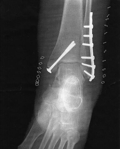 Injury XRay with Hardward