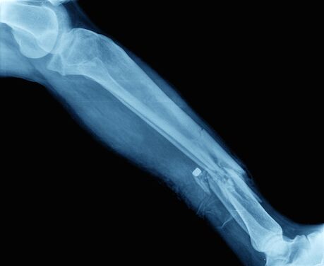 X-Ray - Comp Injury